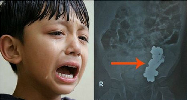 X-Ray-SHOCKS-Doctors-After-Child-Complains-Of-AGONIZING-Stomach-Pain