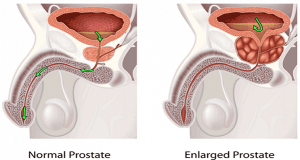 prostata
